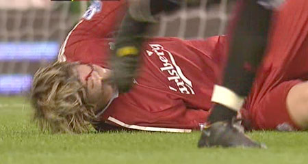 torres-injury