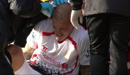 Martin Skrtel gets his head stapled at Bournemouth